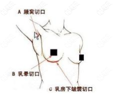 假體取出切口 假體取出切口
