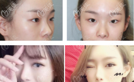 深圳希思雙眼皮案例 深圳希思雙眼皮案例