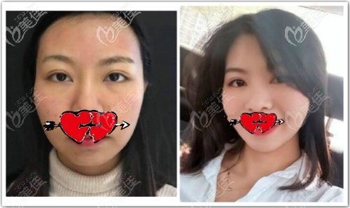 面部微創(chuàng)懸吊提升術(shù)前后對(duì)比