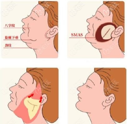面部微創(chuàng)懸吊提升術(shù)操作步驟