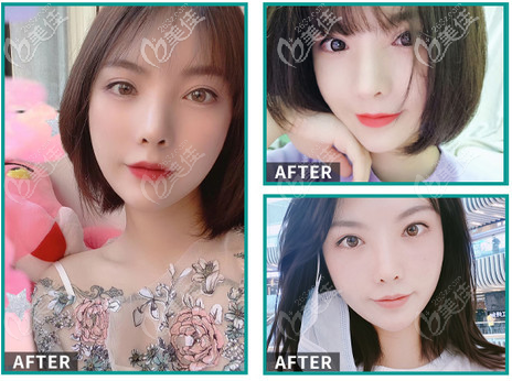 我找北京做鼻修復(fù)厲害的彤美李長賦手術(shù)案例 我找北京做鼻修復(fù)厲害的彤美李長賦手術(shù)案例