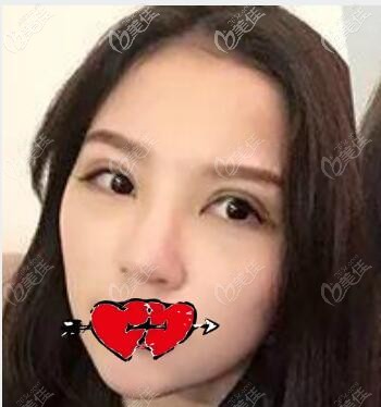 武漢涵美馮曉玲割雙眼皮術(shù)后第7天效果