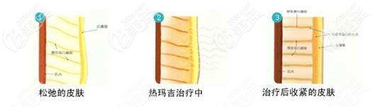 熱瑪吉治療的效果 熱瑪吉治療的效果