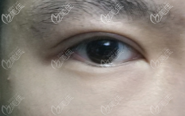 腫泡眼恢復(fù)到30天的樣子還是有肉條感 腫泡眼恢復(fù)到30天的樣子還是有肉條感