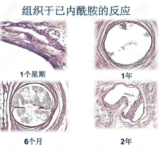 阿普托斯德國埋線提升線材的吸收時間