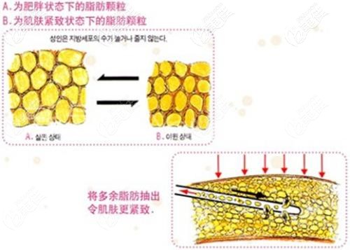 魏瑞鎖做環(huán)形立體吸脂術(shù) 魏瑞鎖做環(huán)形立體吸脂術(shù)