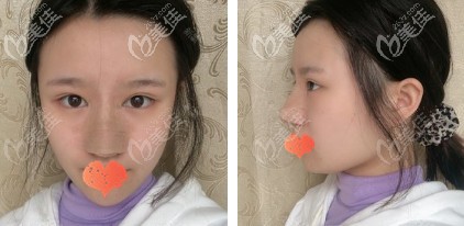 鼻綜合術(shù)后3天鼻子微腫