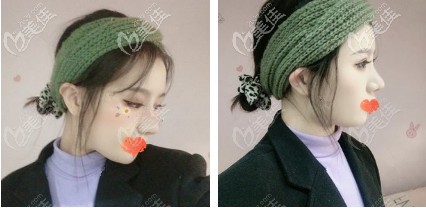 拆完線的鼻子看著很有型