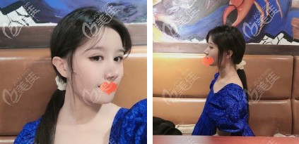 做耳軟骨隆鼻術(shù)后鼻子有較大改變