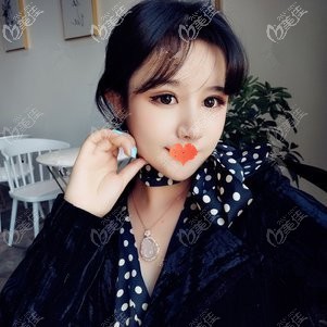 我做鼻綜合3個月的感受：之前所擔(dān)心的耳軟骨完全吸收和變形問題都沒有發(fā)生