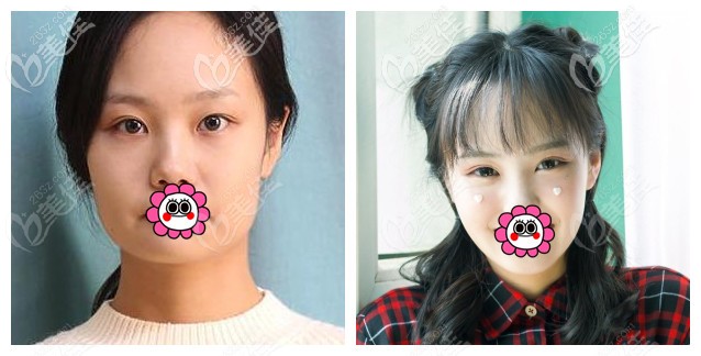 沈陽杏林朱石江下頜角案例 沈陽杏林朱石江下頜角案例