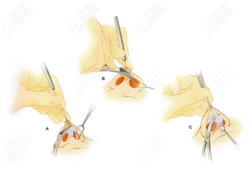 翟彥剛擅長(zhǎng)做鼻綜合手術(shù)