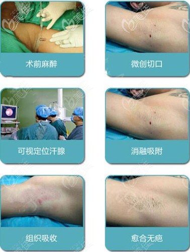 深圳軍科治療腋臭郭晨 深圳軍科治療腋臭郭晨