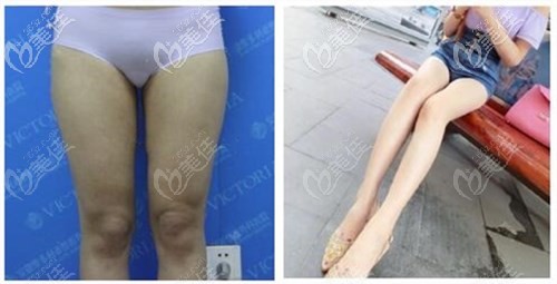 合肥維多利亞大腿吸脂案例