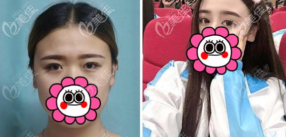 沈陽杏林張瑩瑩雙眼皮案例 沈陽杏林張瑩瑩雙眼皮案例