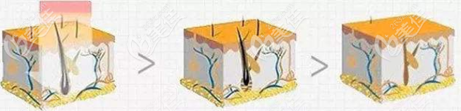激光脫毛作用原理示意圖 激光脫毛作用原理示意圖