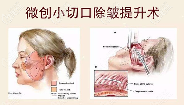 微創(chuàng)小切口除皺術(shù) 微創(chuàng)小切口除皺術(shù)