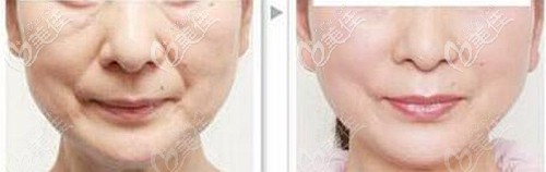 中山美南華做面部埋線提升的費(fèi)用