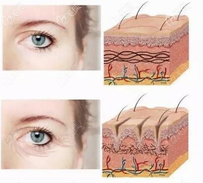 注射嗨體去除眼部皺紋對比照