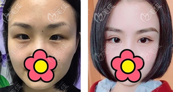 內(nèi)雙可以割雙眼皮嗎