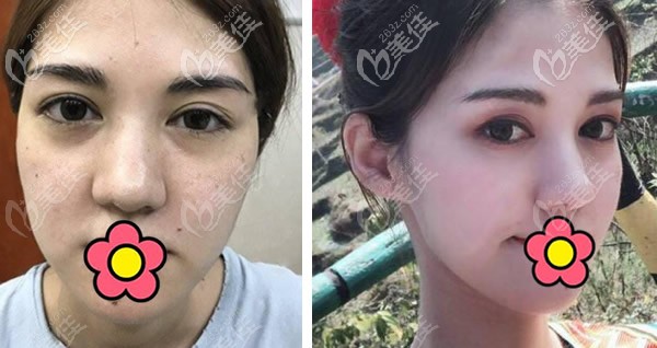 蘭州韓美歪鼻矯正+激光祛斑效果圖