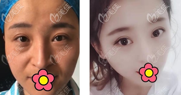 蘭州韓美陽贊生內(nèi)切去眼袋+全臉脂肪填充三個(gè)月恢復(fù)圖