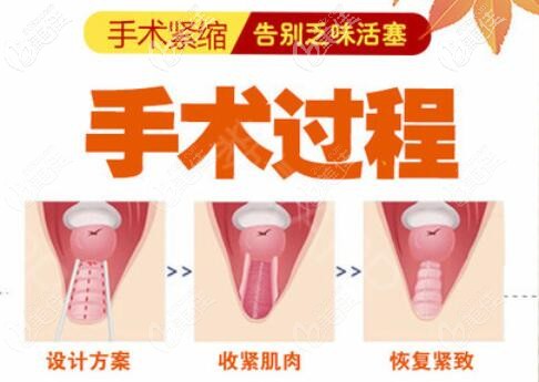 縮陰手術(shù)操作步驟