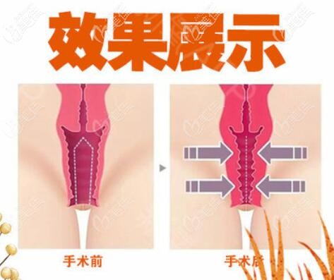 縮陰術(shù)后效果對(duì)比