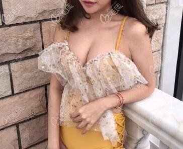 做假體隆胸后填充自體脂肪半年效果圖 做假體隆胸后填充自體脂肪半年效果圖