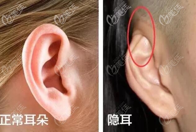 正常耳朵和隱耳的區(qū)別