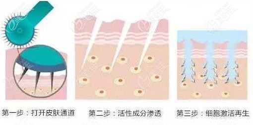 微針治療黑眼圈的原理過(guò)程示意圖 微針治療黑眼圈的原理過(guò)程示意圖