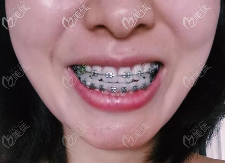 雖然美國(guó)damon自鎖托槽的價(jià)格比國(guó)產(chǎn)的貴些，但感覺(jué)真的好