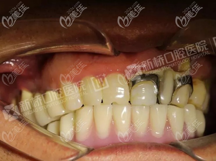  口腔下半口種6顆即刻負重種植牙的案例來啦