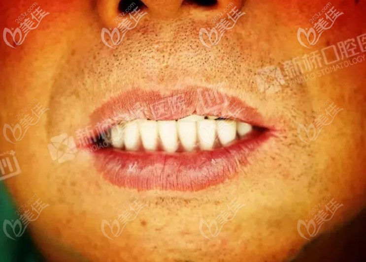 做完種植牙后的牙齒情況