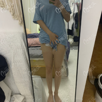 重慶好美羅<!--<i data=20240703-sp></i>-->大腿吸脂術(shù)后一個(gè)月