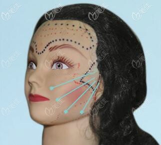 面部微創(chuàng)懸吊提升埋線位置圖解