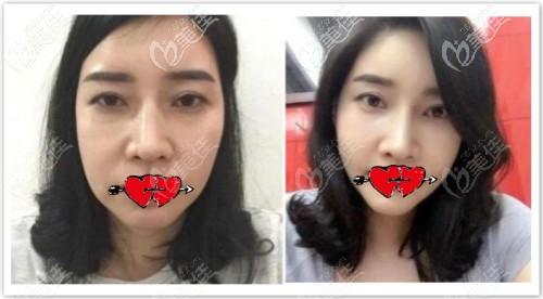 做面部微創(chuàng)筋膜懸吊提升兩年效果前后對比 做面部微創(chuàng)筋膜懸吊提升兩年效果前后對比