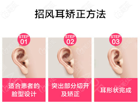 廣州高尚余文林醫(yī)生招風(fēng)耳矯正過程 廣州高尚余文林醫(yī)生招風(fēng)耳矯正過程