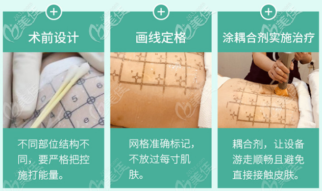 熱瑪吉去除妊娠紋治療過程 熱瑪吉去除妊娠紋治療過程