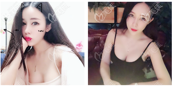 感覺(jué)佛山美萊曾昂豐胸技術(shù)特別好