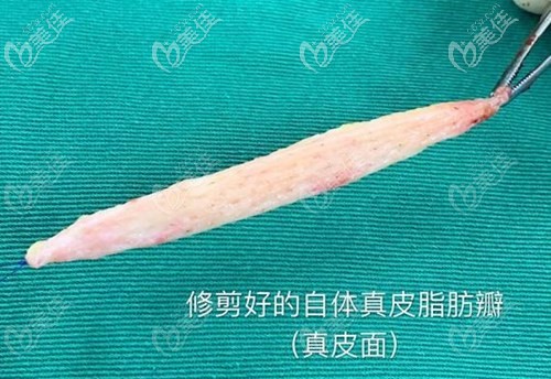 自體真皮瓣組織 自體真皮瓣組織
