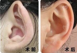 小孩招風(fēng)耳矯正術(shù)后一年效果圖 小孩招風(fēng)耳矯正術(shù)后一年效果圖