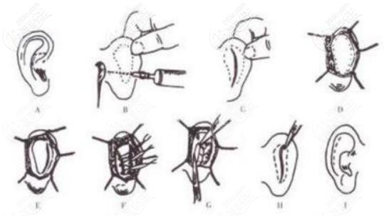 招風(fēng)耳矯正手術(shù)方法操作過(guò)程圖解 招風(fēng)耳矯正手術(shù)方法操作過(guò)程圖解