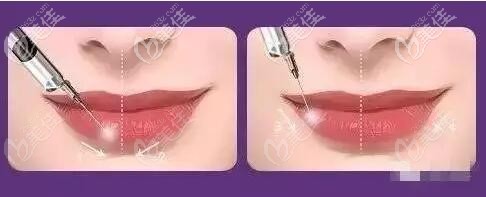 玻尿酸豐唇位置 玻尿酸豐唇位置