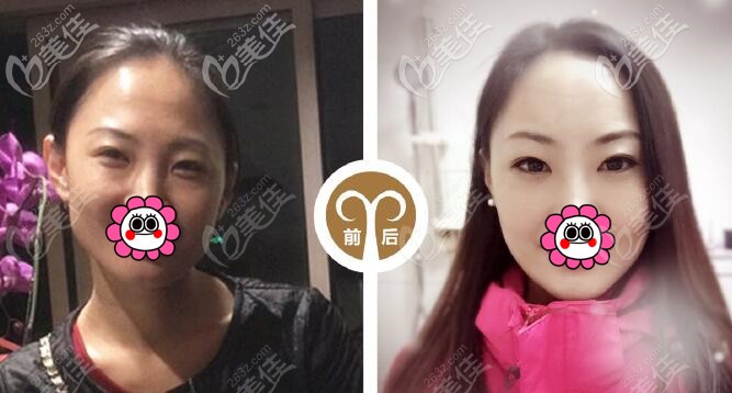 不開刀縮下頜角效果 不開刀縮下頜角效果