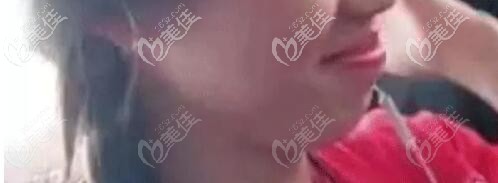 二次矯正前的側(cè)臉 二次矯正前的側(cè)臉