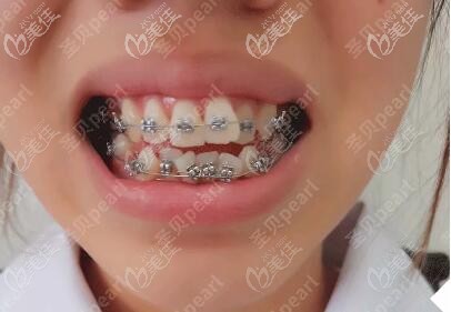 二次矯正初戴牙套 二次矯正初戴牙套