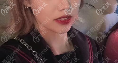 換成陶瓷半隱形牙套后 換成陶瓷半隱形牙套后