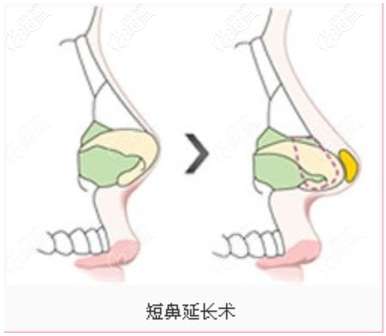 短鼻延長(zhǎng)圖 短鼻延長(zhǎng)圖