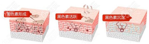 激光美白的原理 激光美白的原理